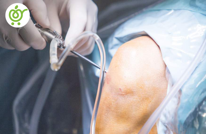 آب-آوردن-زانو-جراحی-و-تعویض-مفصل-874