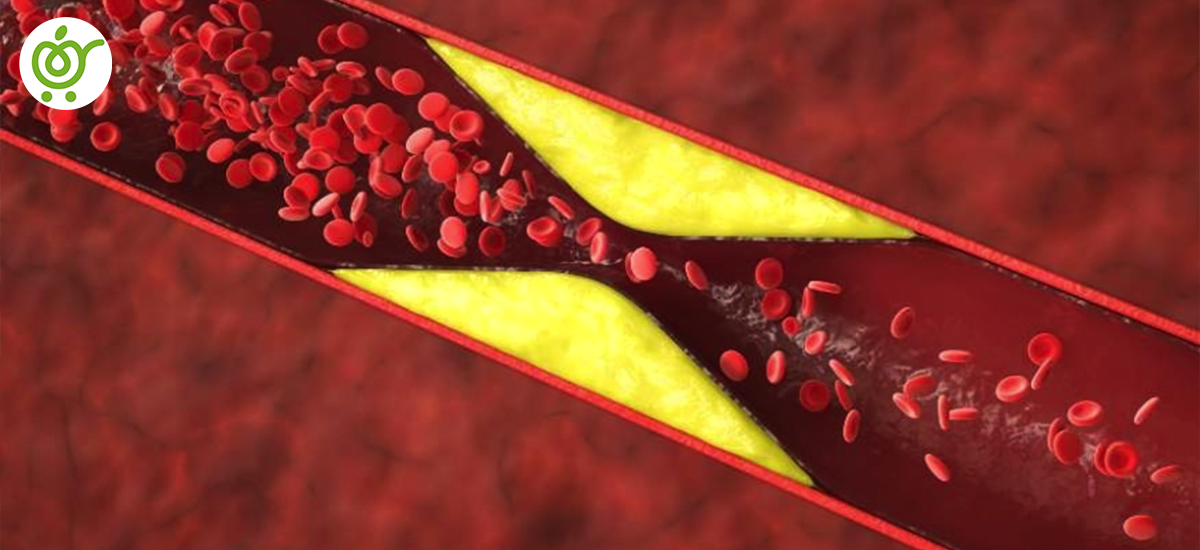آترواسکلروز آترواسکلروز