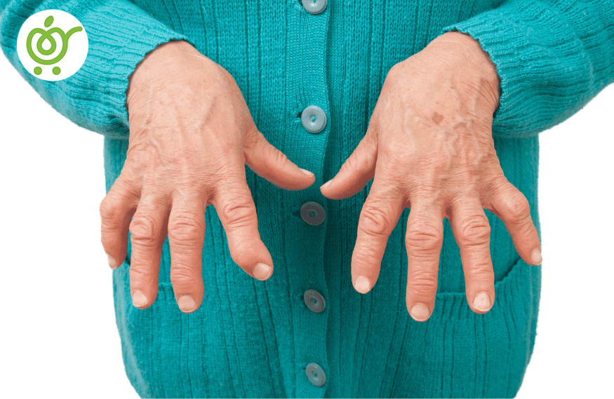 آرتروز-انگشتان-66 آرتروز-انگشتان-66