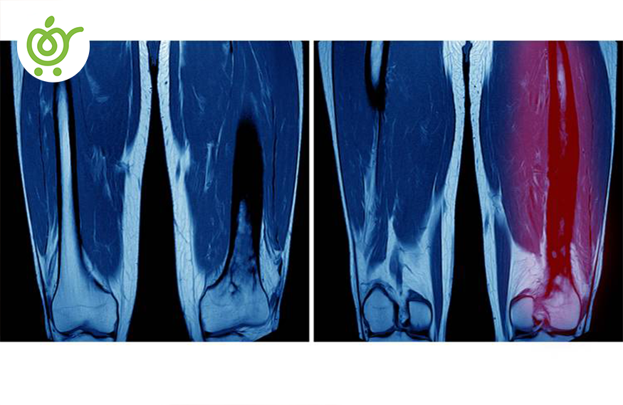 استئومیلیت-65