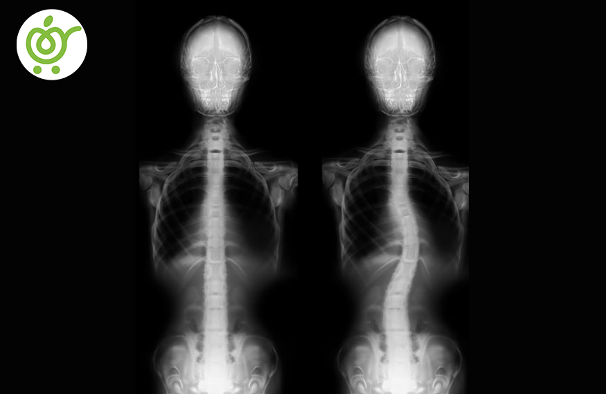 اسکولیوز-یا-کجی-ستون-فقرات اسکولیوز-یا-کجی-ستون-فقرات