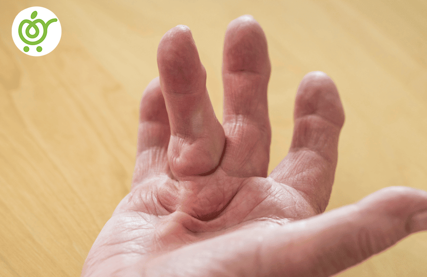 انقباض-دوپویترن-45 انقباض-دوپویترن-45