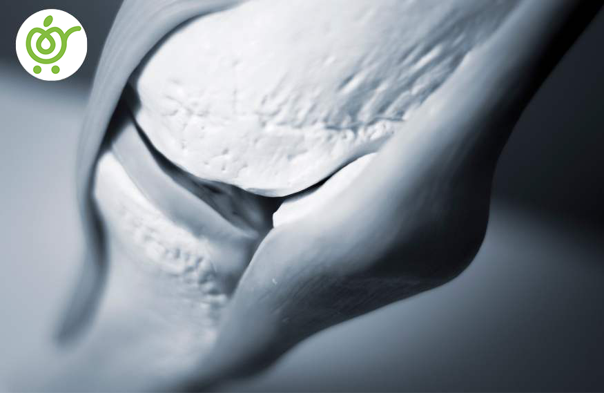 انواع-پارگی-مینیسک-زانو-32