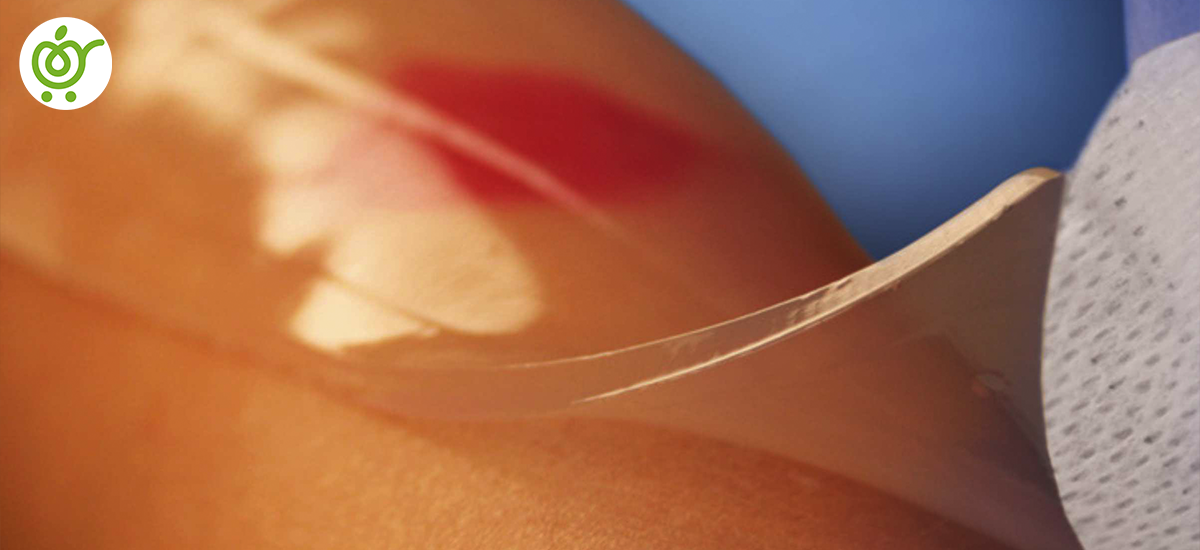 انواع-پانسمان-هیدروژل انواع-پانسمان-هیدروژل