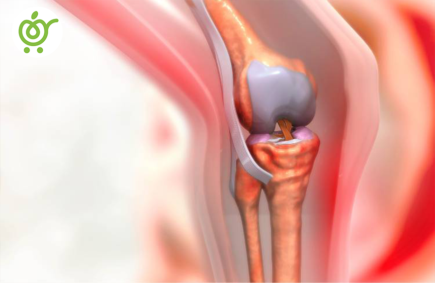 تعویض-مفصل-زانو-85