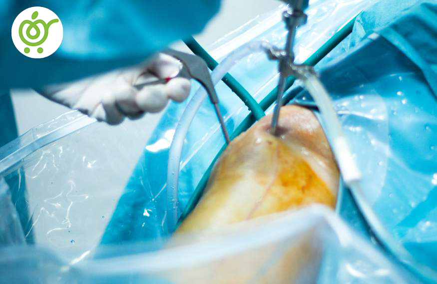جراحی-زانو-برای-درمان-پارگی-مینیسک-6