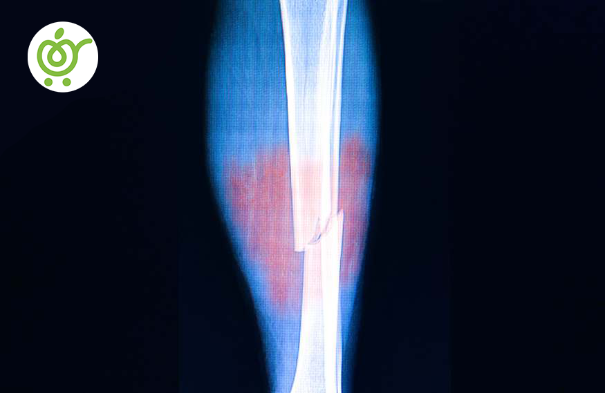 درد-استخوان-چگونه-است؟-88