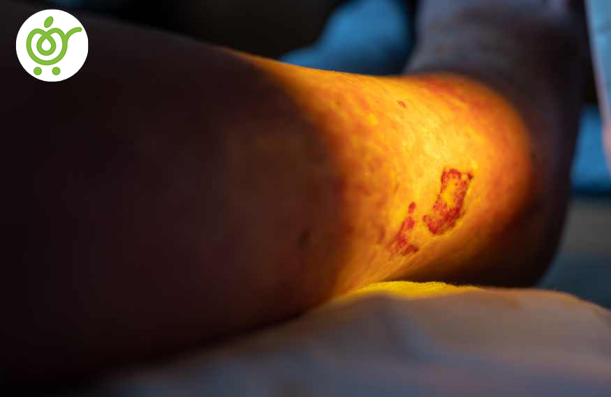 درمان-زخم-بستر-از-طریق-جراحی-65