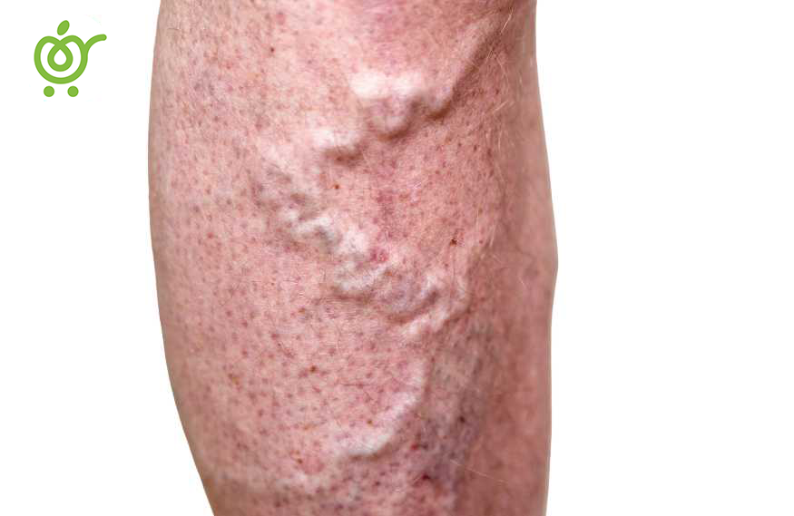 دلیل-ایجاد-رگ‌های-واریسی-76