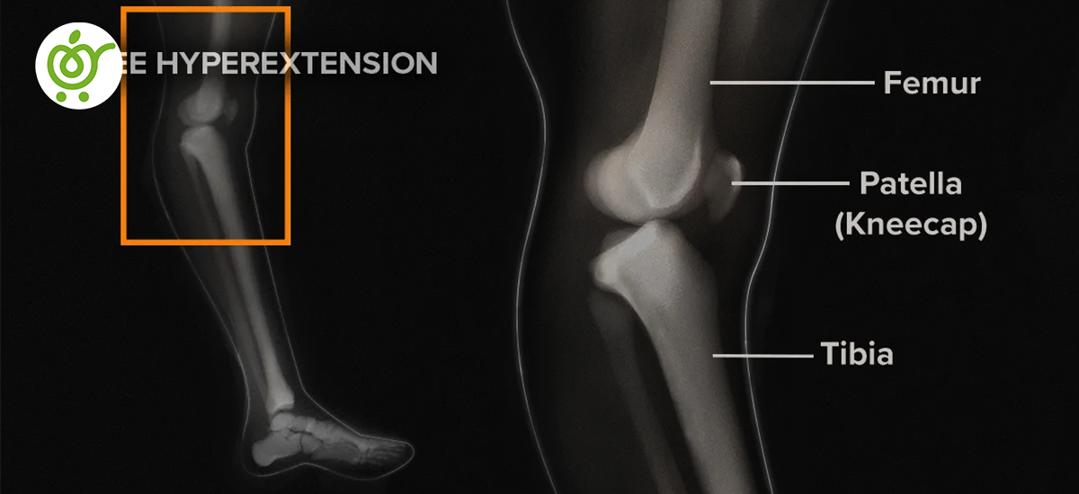 دلیل-عقب-زدگی-زانو-چیست؟ دلیل-عقب-زدگی-زانو-چیست؟