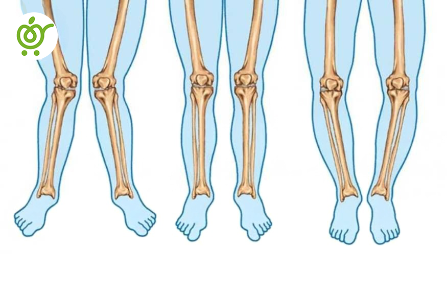 راه‌های-درمان-زانوی-خمیده