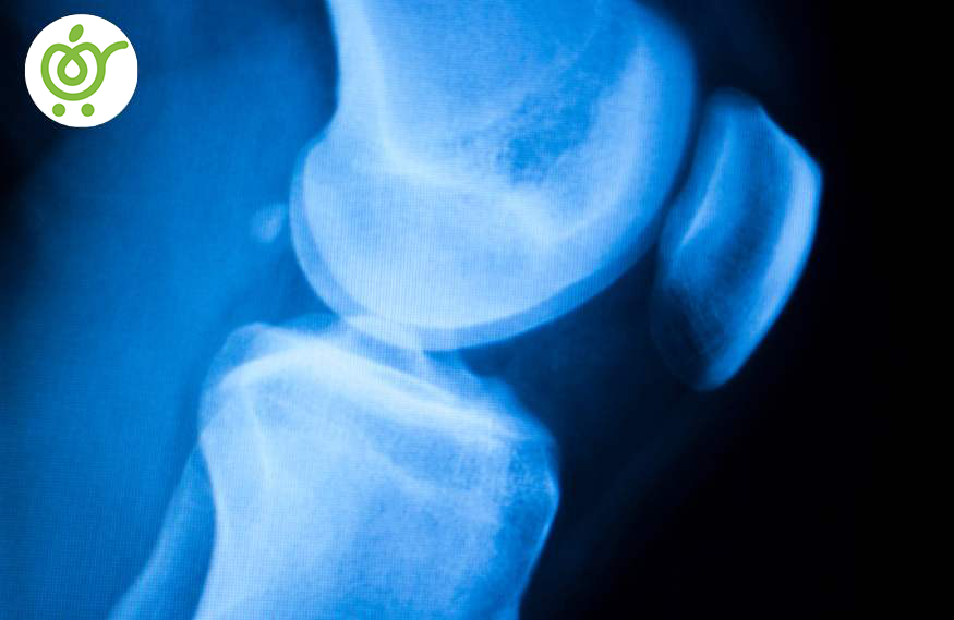 راه‌های-پیشگیری-از-پارگی-مینیسک-42