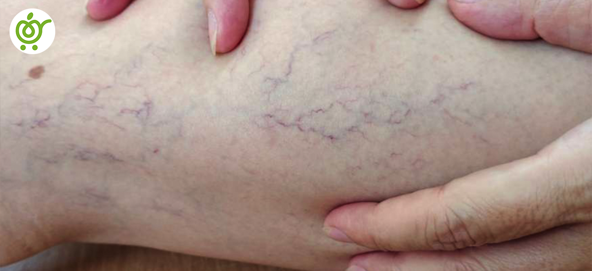 رگهای-واریسی رگهای-واریسی