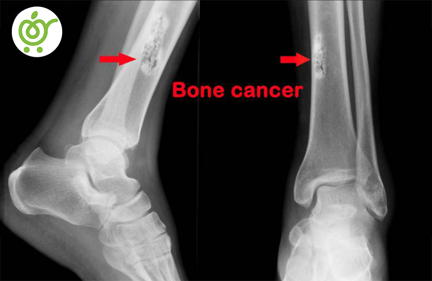 سرطان-استخوان-84