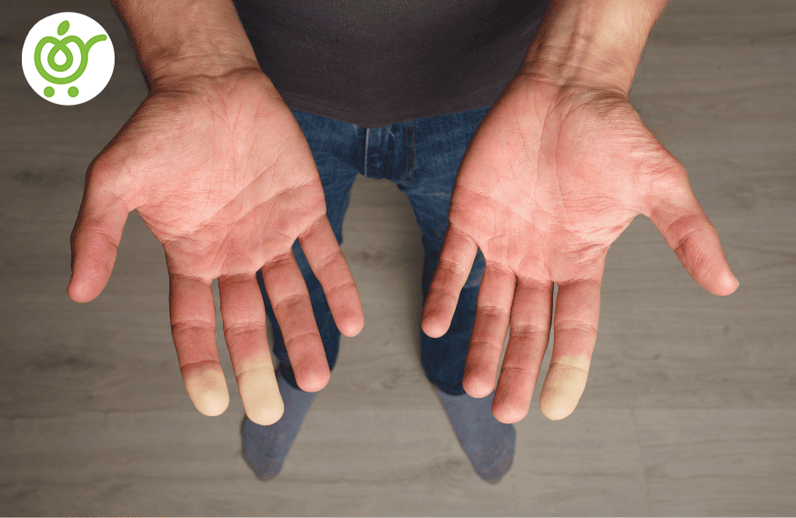 سندرم-رینو-55 سندرم-رینو-55