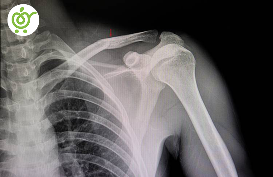 شکستگی-استخوان-44