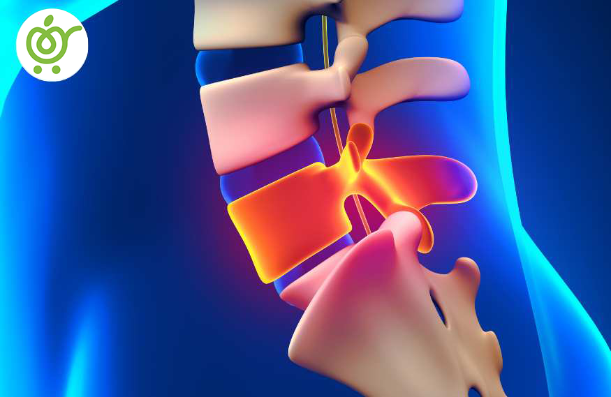 علائم-دیسک-کمر-چیست-88 علائم-دیسک-کمر-چیست-88