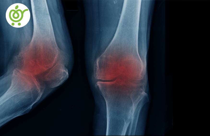 علل-ایجاد-آرتروز-زانو-چیست؟-47 علل-ایجاد-آرتروز-زانو-چیست؟-47