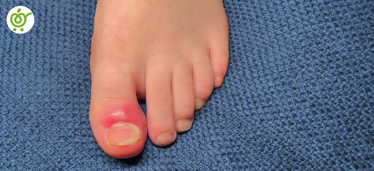 علل-در-رفتگی-انگشت-پا