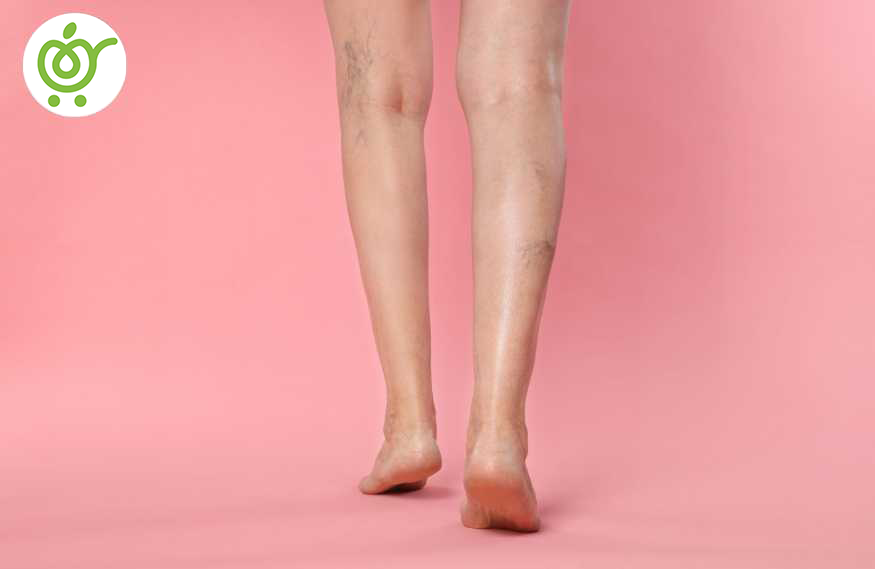 نحوه-ایجاد-رگ‌های-واریسی-745