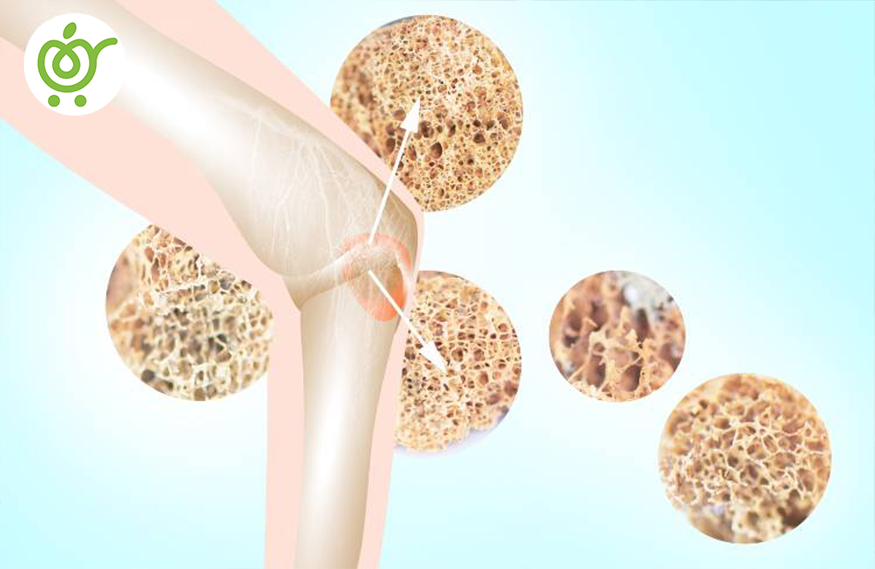 پوکی-استخوان-241