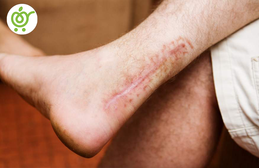 پیشگیری-از-پارگی-تادون-آشیل-پا-758 پیشگیری-از-پارگی-تادون-آشیل-پا-758