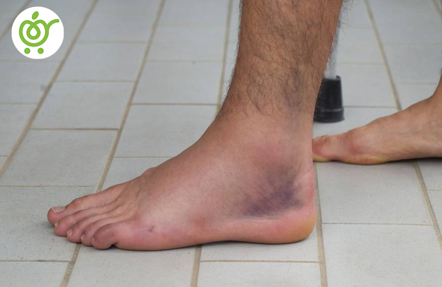 پیشگیری-از-پیچ-خوردگی-مچ-پا-74