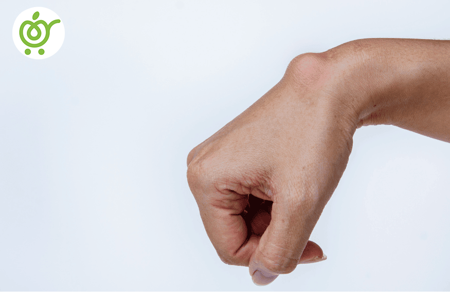 کیست-گانگلیون-78 کیست-گانگلیون-78