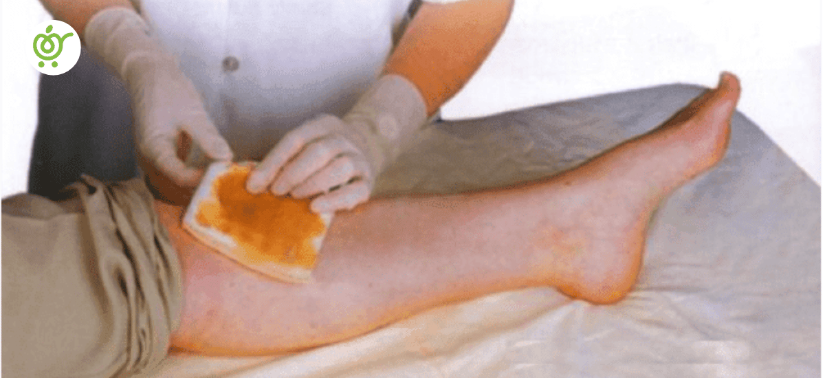 با خرید پانسمان عسل، میتوانید از مزیتهای آن بهره گیرید.