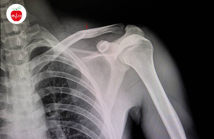 شکستگی استخوان می‌تواند در برخی موارد توسط دکتر ارتوپد، تشخیص داده شود.