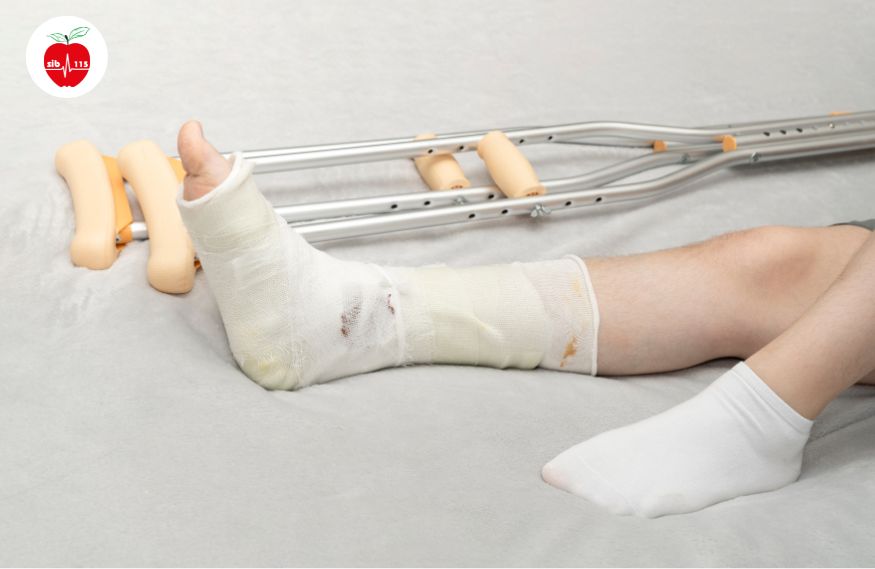 برای جلوگیری از آسیب و شروع روند درمانی درد مچ پا، می‌توانید برای مدتی پا را گچ بگیرید.