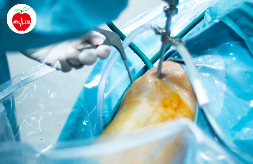 برای درمان پارگی مینیسک زانو، جراحی آخرین مرحله می‌باشد.