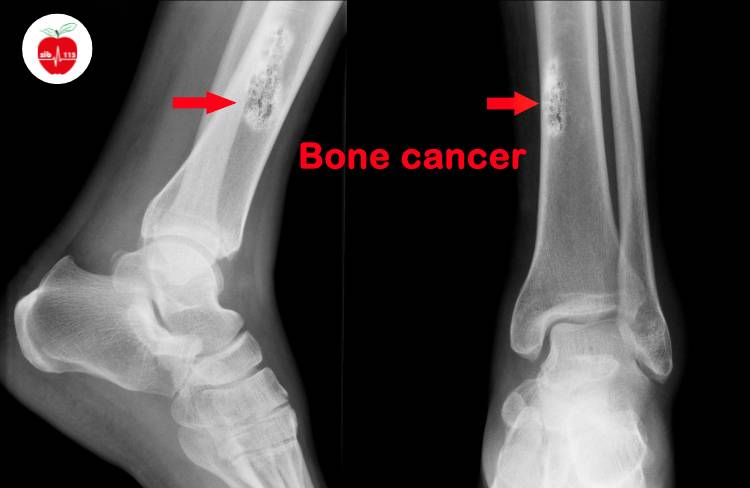 سرطان استخوان می‌تواند در برخی موارد توسط دکتر ارتوپد، تشخیص داده شود.