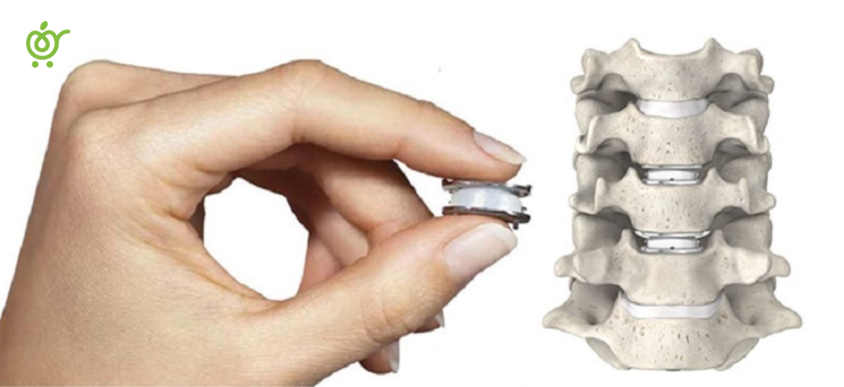 Artificial-Disc-Replacement