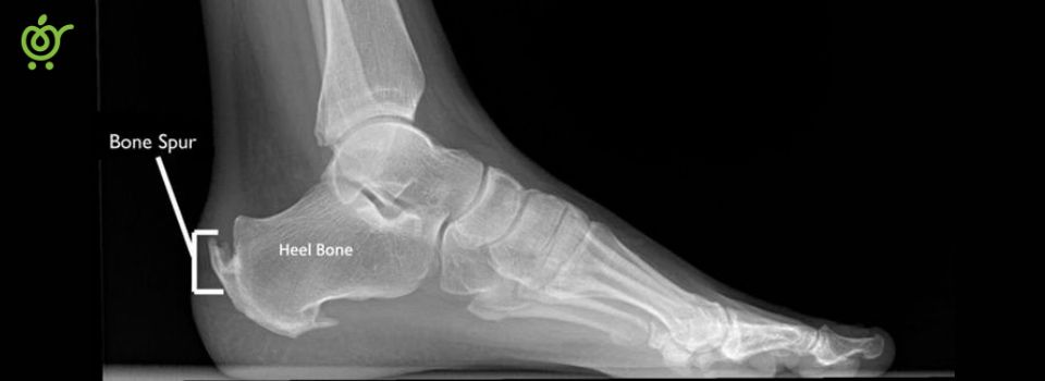 Bone-spur Bone-spur