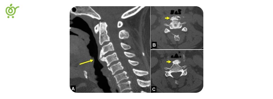 Cervical-Disc-Osteophyte-Complex Cervical-Disc-Osteophyte-Complex