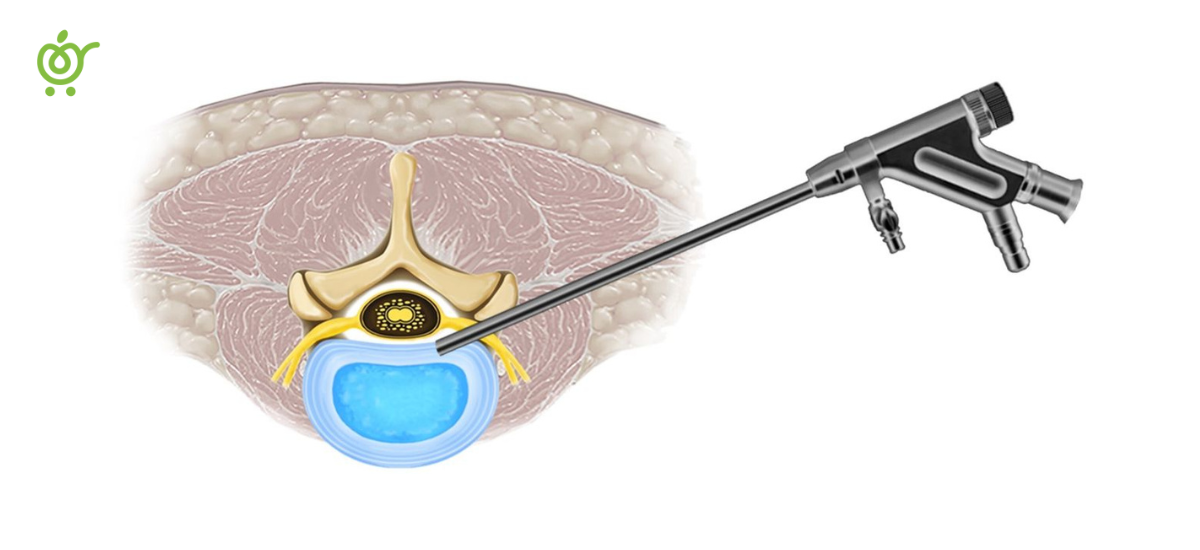 Discectomy