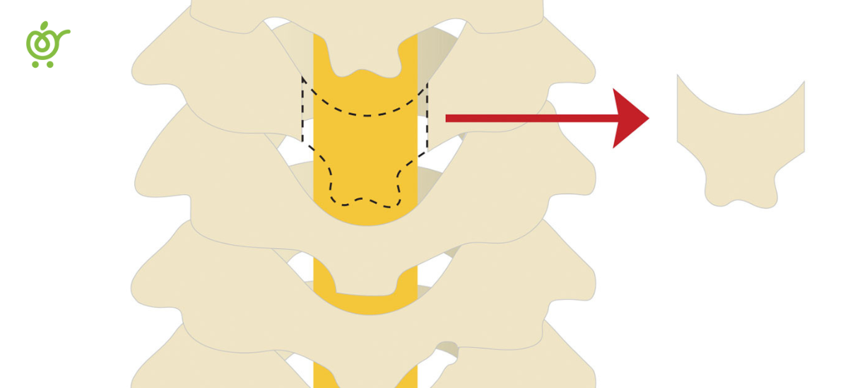 Laminectomy