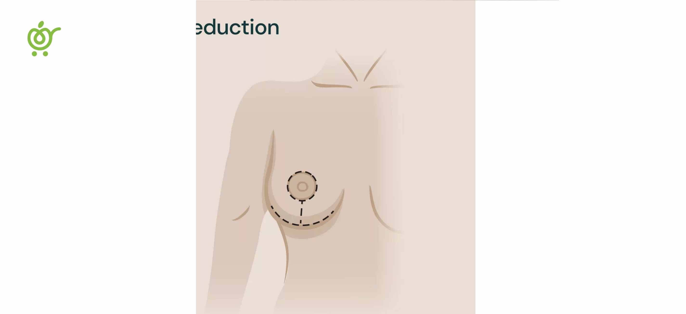 Peri-areolar-or-Donut-Incision