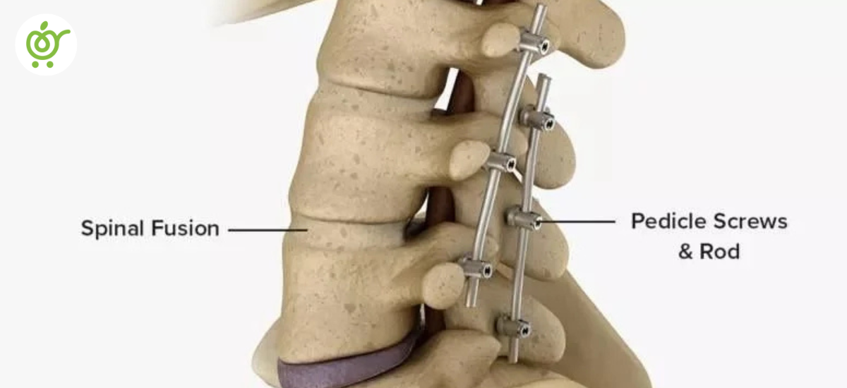 Spinal-Fusion