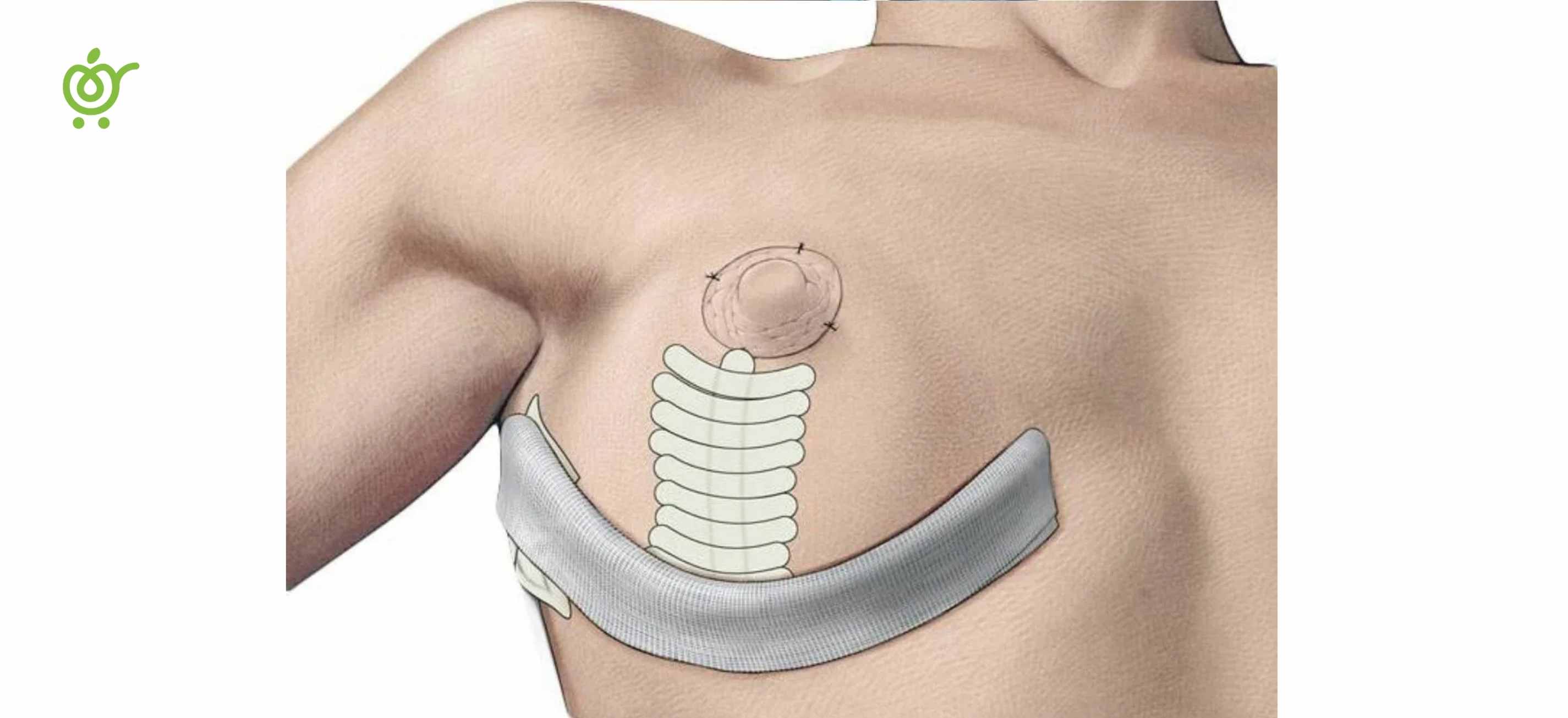 Vertical-or-Lollipop-Incision