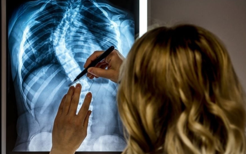 از-عوامل-موثر-تا-درمان-موثر-انحراف-ستون-فقرات