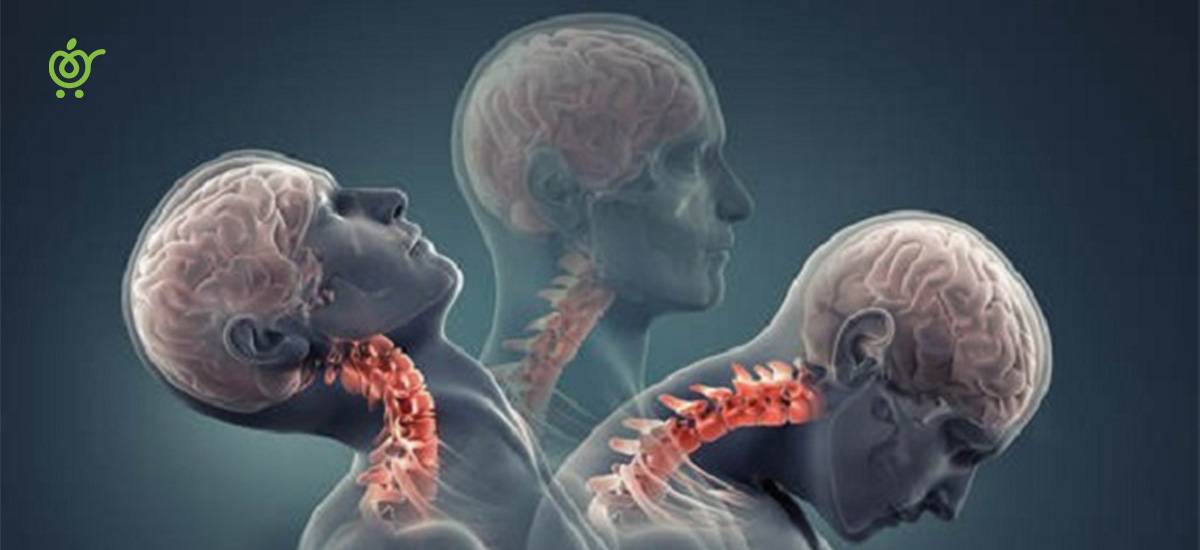 اسکولیوز-003