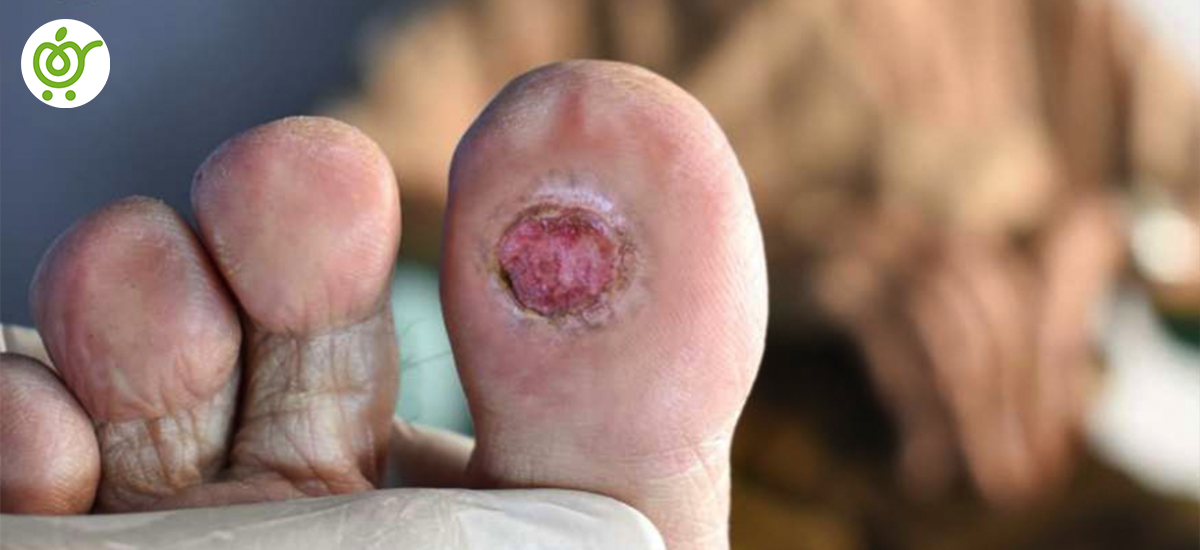 انواع-زخم‌های-پا