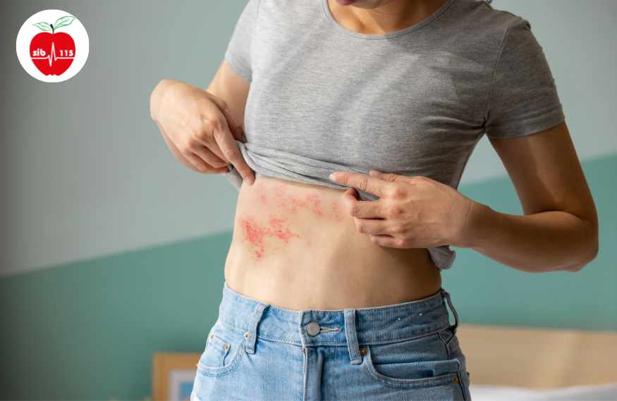 بیماری-زونا-چیست بیماری-زونا-چیست