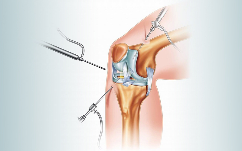 تصویر-آرتروسکوپی-زانو تصویر-آرتروسکوپی-زانو