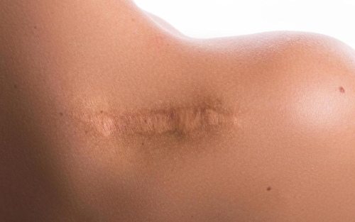 تصویر-شاخص-زخم-اسکار