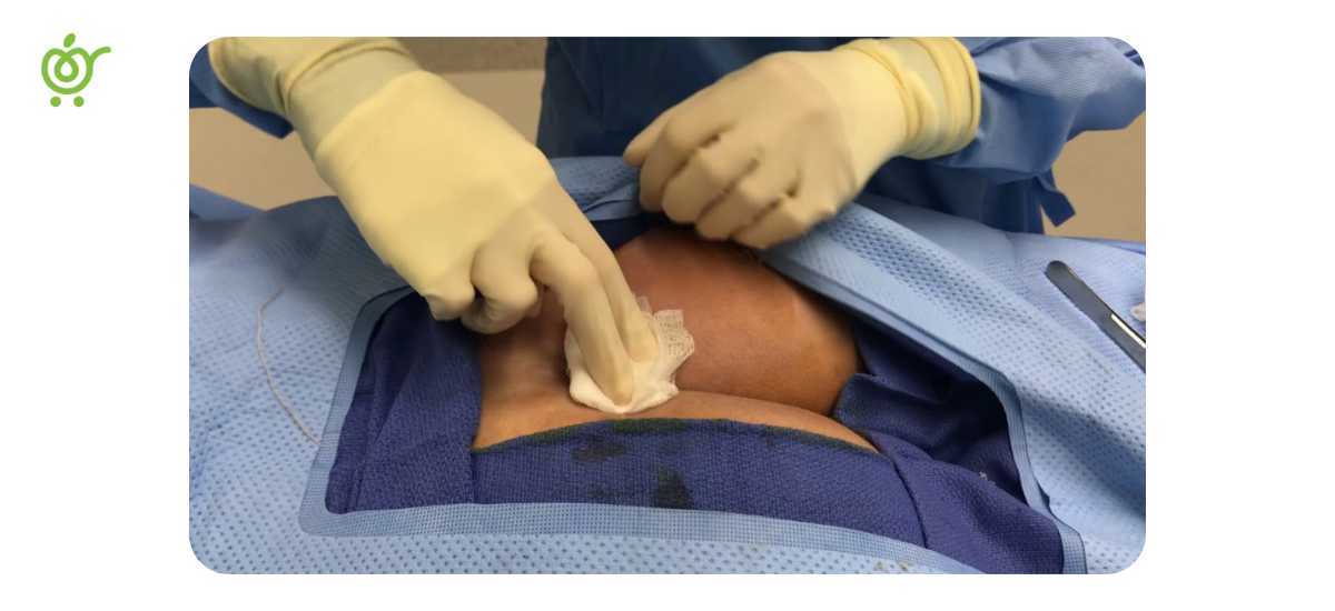 تعویض-پانسمان-کیست-مویی-1 تعویض-پانسمان-کیست-مویی-1