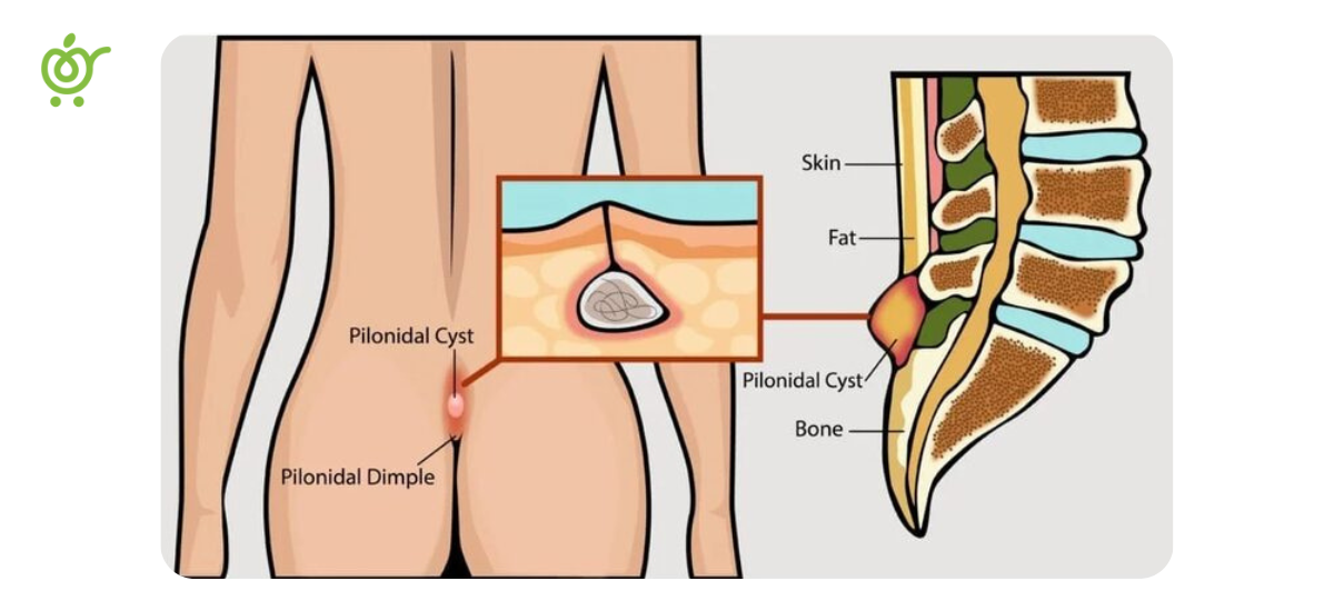 تعویض-پانسمان-کیست-مویی-2 تعویض-پانسمان-کیست-مویی-2