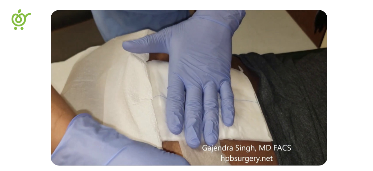 تعویض-پانسمان-کیست-مویی تعویض-پانسمان-کیست-مویی